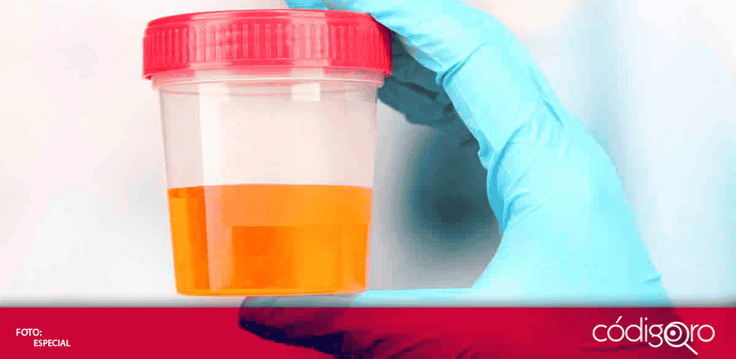 Con prueba de orina podrían diagnosticar cáncer de pulmón