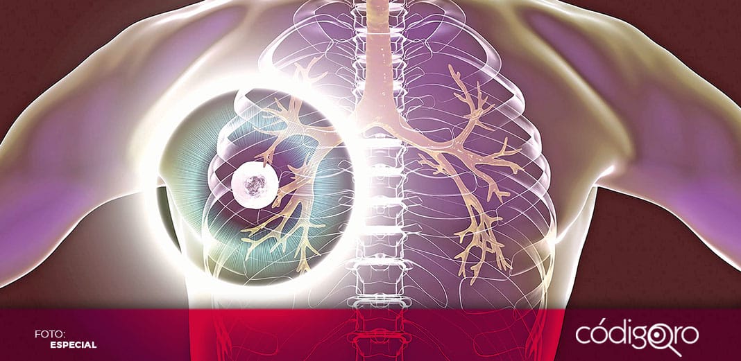 Incrementan muertes por tuberculosis por primera vez en más de una década