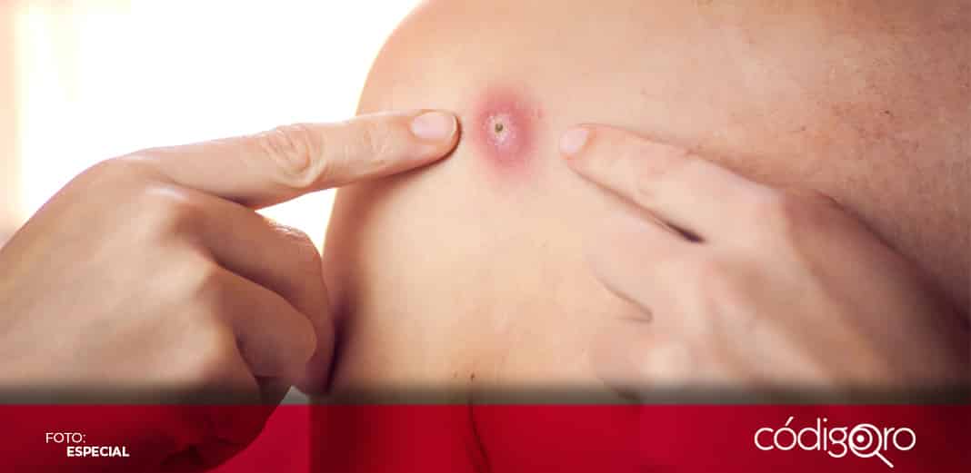 No se prevé pandemia por viruela del mono: Colegio Médico