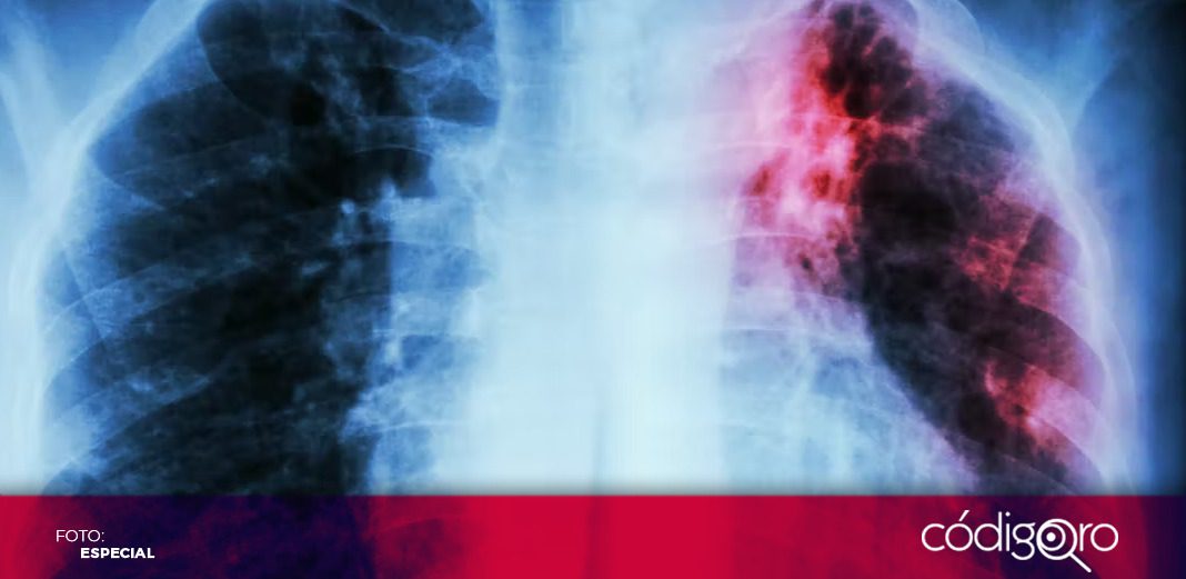 Se suma SESA a la conmemoración del Día Mundial de la Tuberculosis