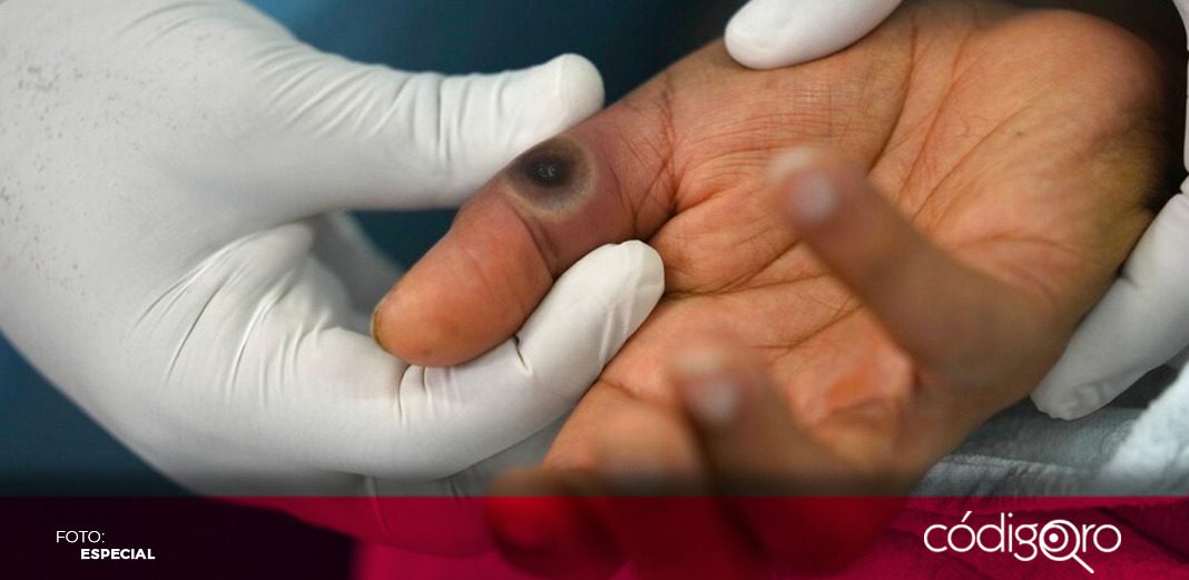 Reciben alta 29 pacientes con viruela símica