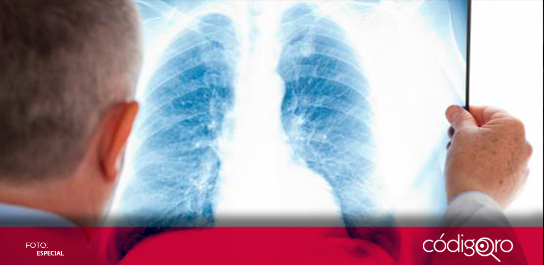 Llaman a hacer conciencia para prevenir cáncer pulmonar