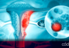Para fomentar la cultura de sensibilización y prevención del cáncer de ovario, SESA invita a las mujeres a acudir al médico para detectar esta enfermedad a tiempo