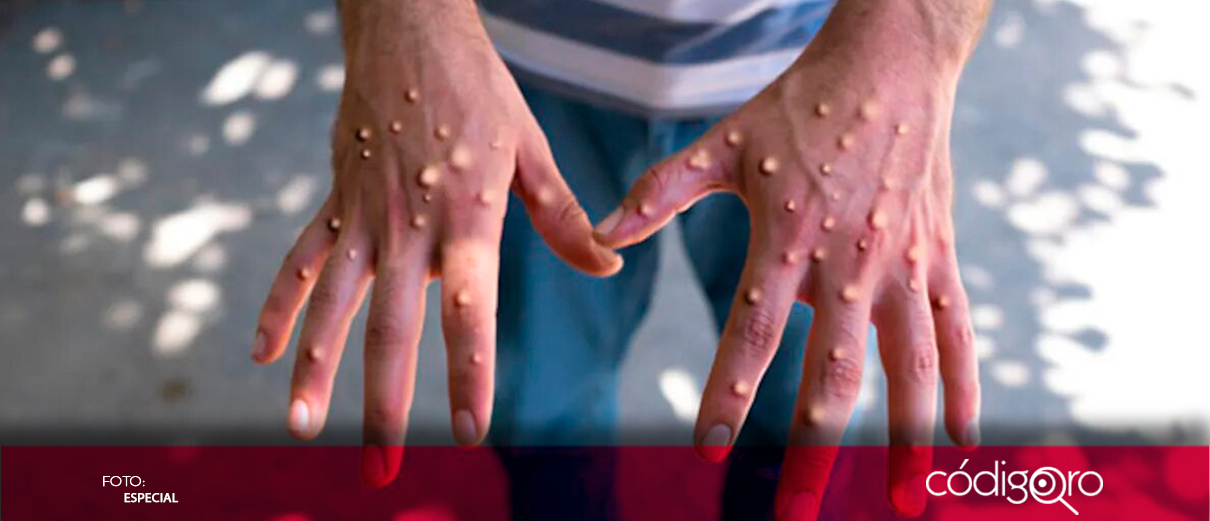 SESA realiza vigilancia epidemiológica de mpox