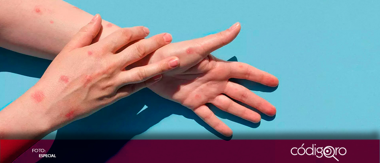 OMS asegura que "mpox" sigue siendo una emergencia de salud