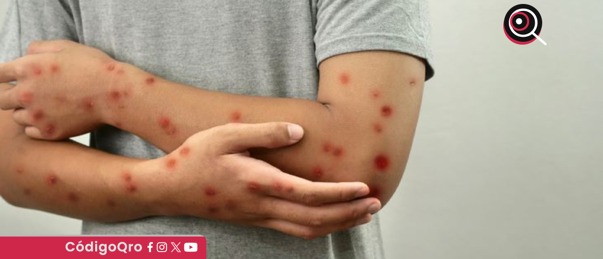 Brote de sarampión en EUA supera los mil casos confirmados